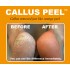Callus Peel 